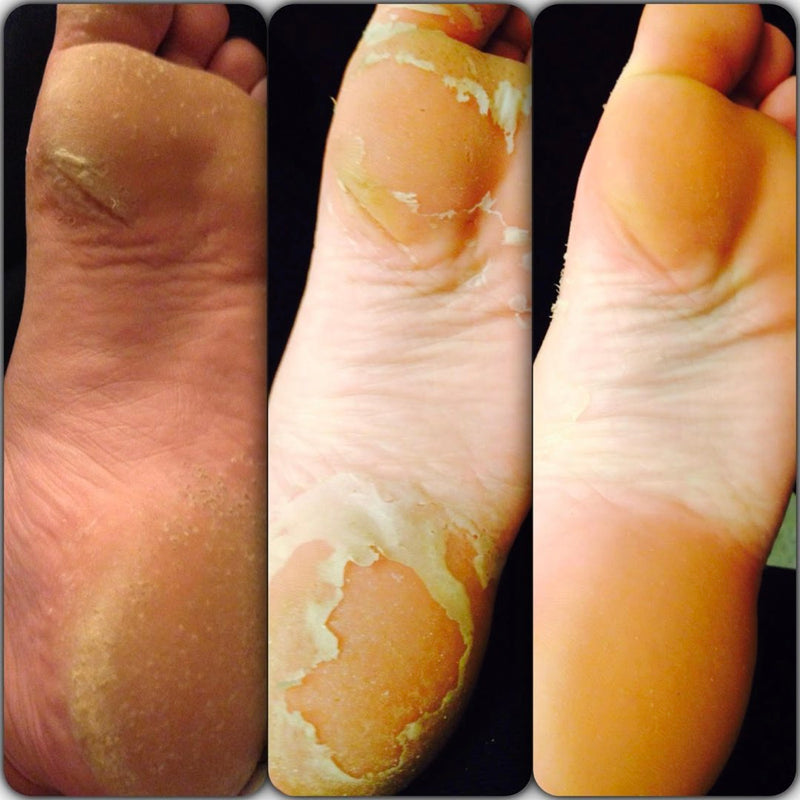 Baby Foot Exfoliation Foot Peel